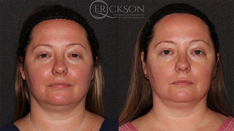 Laser Resurfacing Before and After Photo by Dr. Erickson in Chicago, IL
