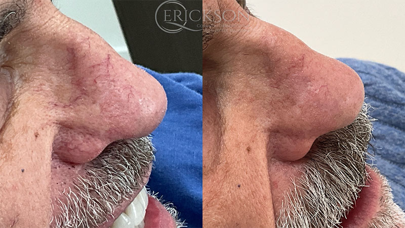 Laser Resurfacing ClearV Before and After Photo by Dr. Erickson in Chicago, IL