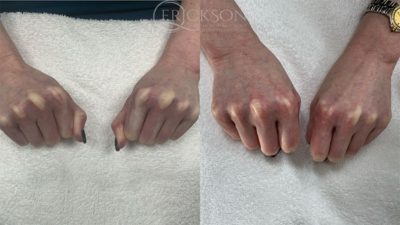 Laser Resurfacing Clearsilk Before and After Photo by Dr. Erickson in Chicago, IL
