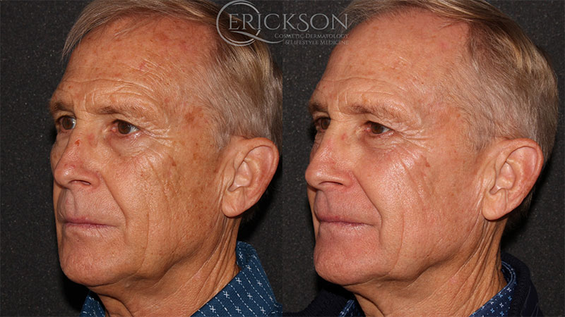 Laser Resurfacing Halo Before and After Photo by Dr. Erickson in Chicago, IL
