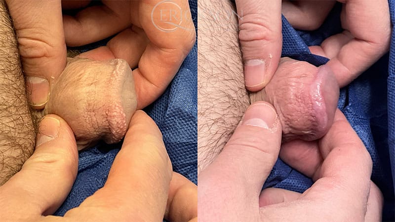 PPL Removal Before and After Photo by Dr. Erickson in Chicago, IL