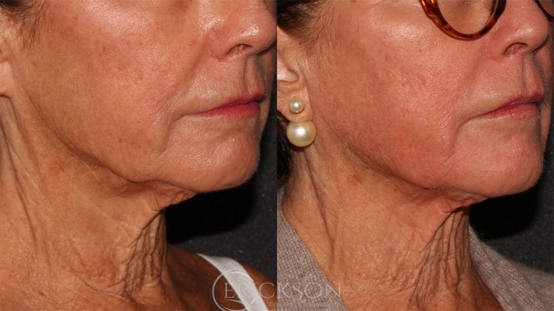 SecretRF Before and After Photo by Dr. Erickson in Chicago, IL