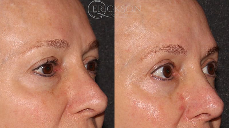 Sofwave™ Before and After Photo by Dr. Erickson in Chicago, IL