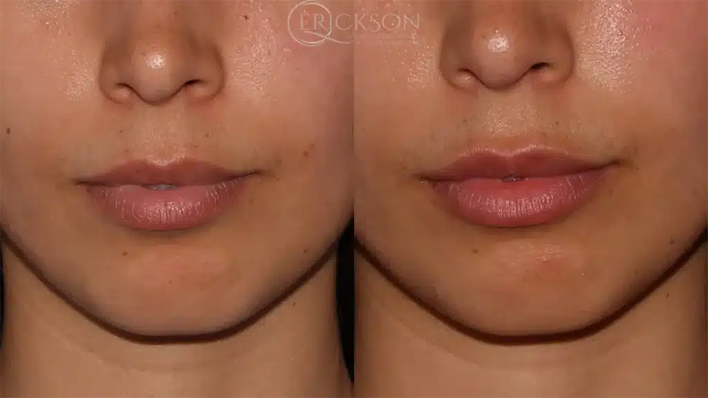 lip filler before and after photo by dr erickson in chicago il