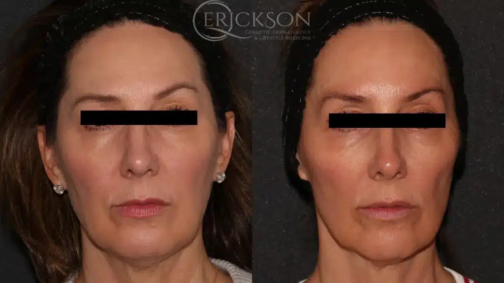 Sofwave Before and After Photo by Dr. Erickson in Chicago IL