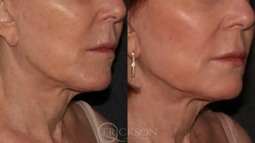 Sofwave Before and After Photo by Dr. Erickson in Chicago IL
