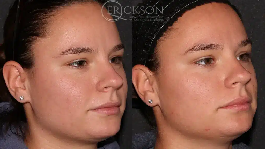 ClearSilk Before and After Photo by Dr. Erickson in Chicago IL