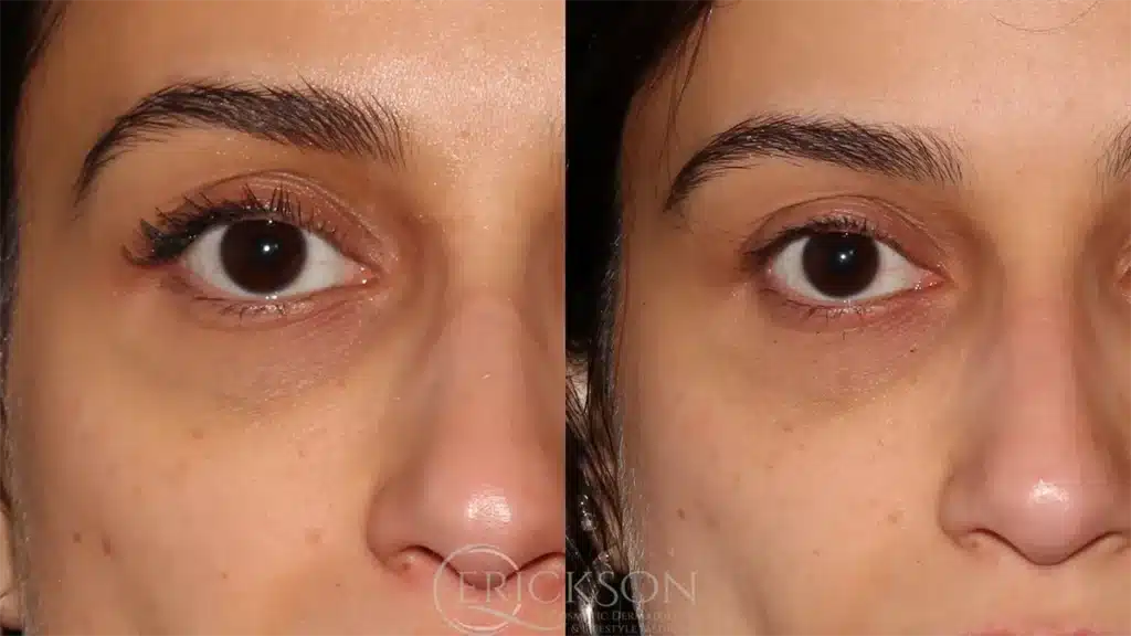 ClearV Before and After Photo by Dr. Erickson in Chicago IL
