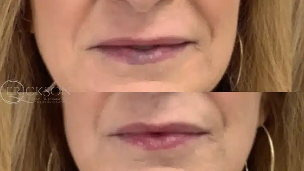 ClearV Before and After Photo by Dr. Erickson in Chicago IL