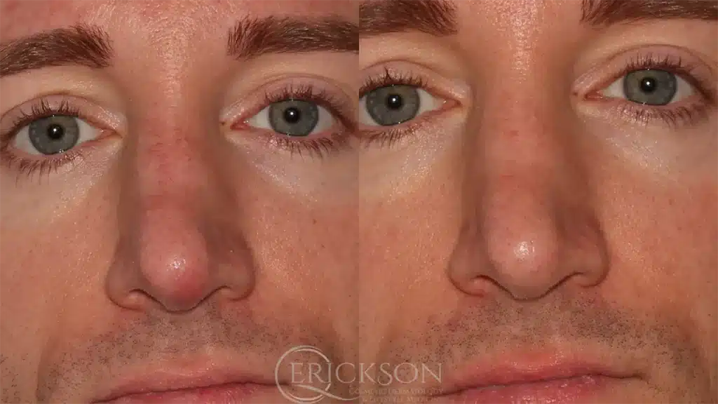 ClearV Before and After Photo by Dr. Erickson in Chicago IL