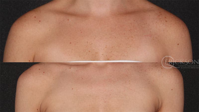 BBL Before and After Photo by Dr. Erickson in Chicago, IL