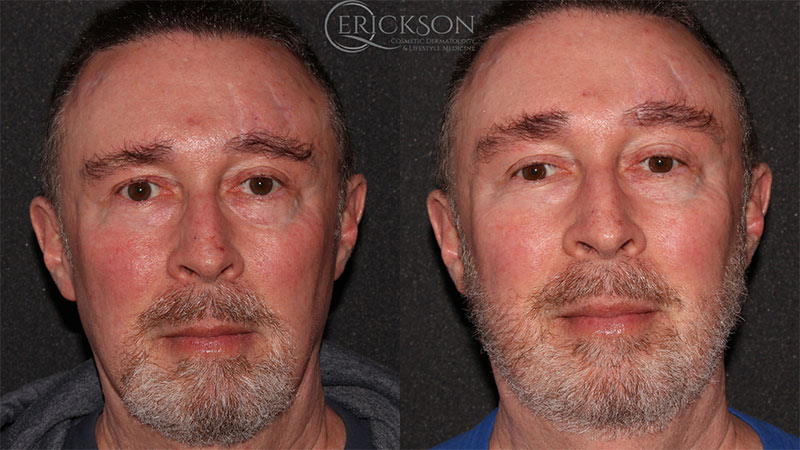 BBL Before and After Photo by Dr. Erickson in Chicago, IL