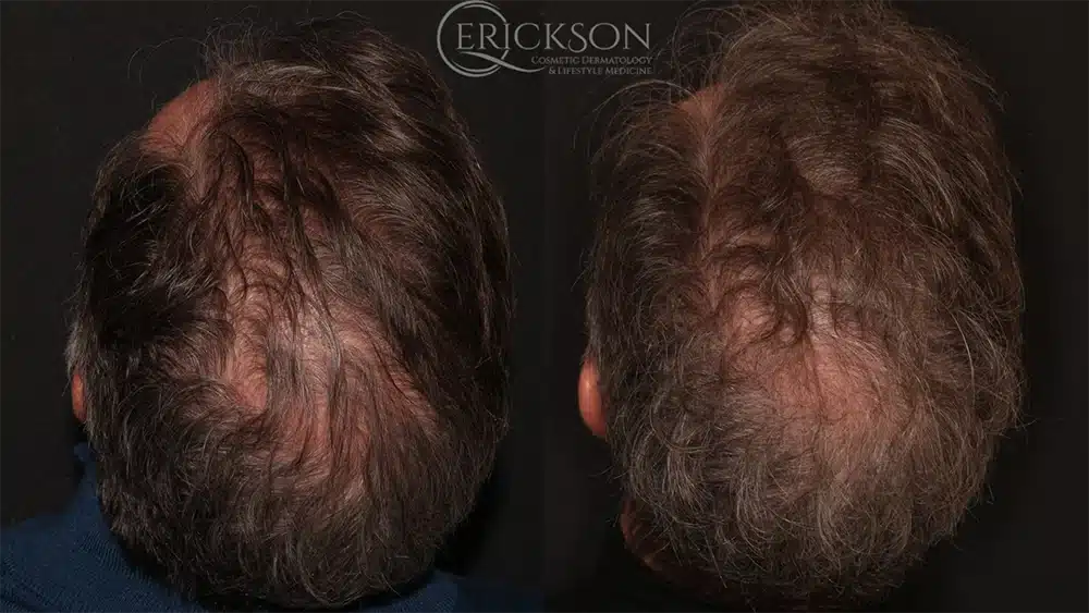 Hair Restoration Before and After Photo by Dr. Erickson in Chicago IL