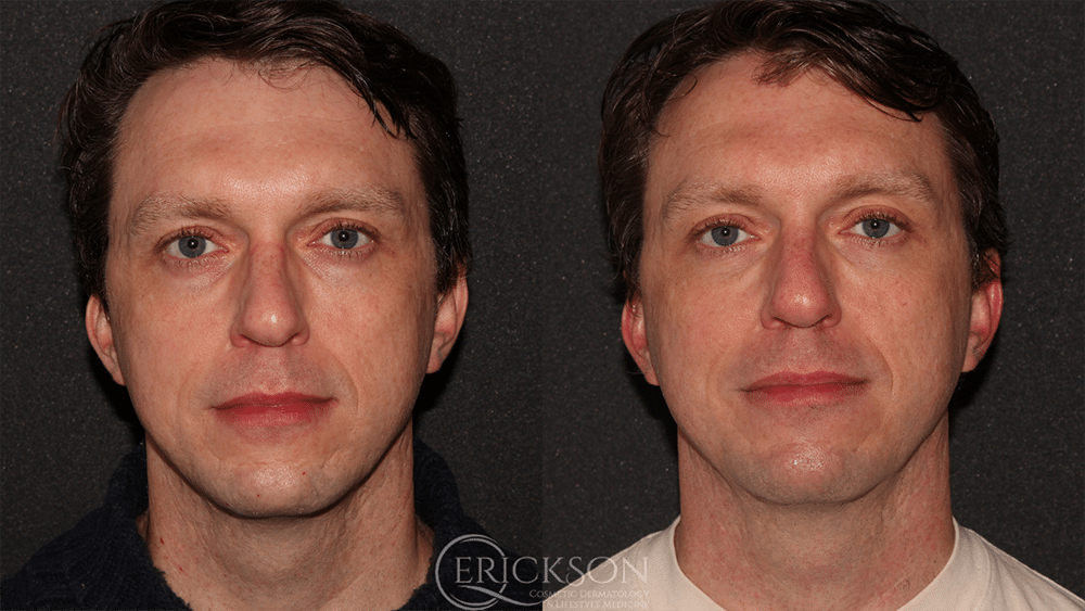 Secret™ RF Before and After Photo by Dr. Erickson in Chicago IL
